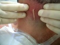 spot cyst squeeze puss