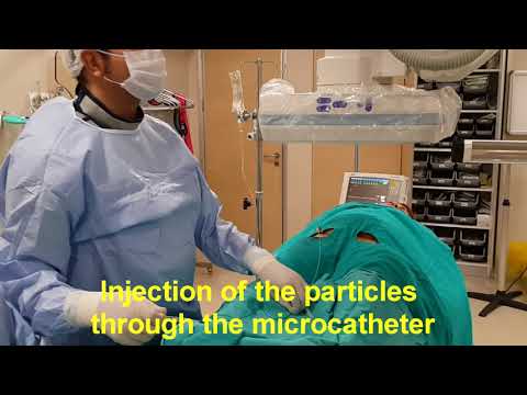 video-linktoworks-FİBROID EMBOLIZATION, PAIN FREE