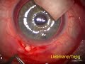 Trabeculectomy with Hyphema