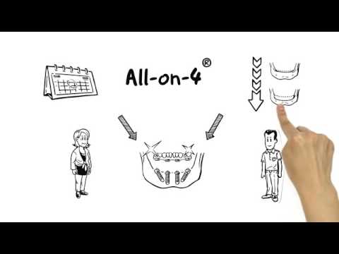All-on-4® treatment concept for failing dentition | Nobel Biocare