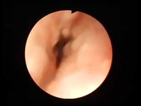 how to cure esophageal varices