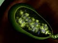 Gallstones Gallstones