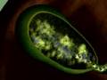 Gallstones
