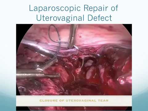 how to repair uterine rupture