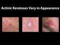 Before Skin Cancer (Health TIp)