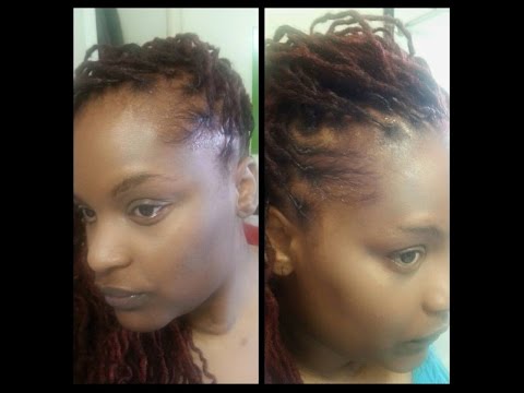 Weight Loss Surgery {Gastric Bypass} Hair Loss After Surgery / LOCS/DREADS Weight Loss Surgery {Gastric Bypass} Hair Loss After Surgery / LOCS/DREADS