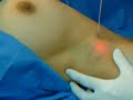 AdvancedAesthetics_Axillary Hyperhidrosis AdvancedAesthetics_Axillary Hyperhidrosis