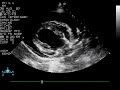 Pericardial Effusion/Cardiac Tamponade - Dog