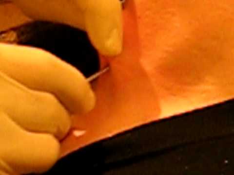 This is my first micro-dermal anchor insertion: Getting micro dermal implant 