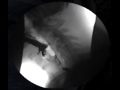 Intra swallow aspiration