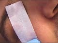 Abrasion corn�enne
