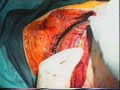 Rib perforator for painless post-thoracotomy recovery