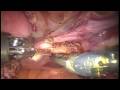 Minimally invasive total hysterectomy using the da Vinci robot.