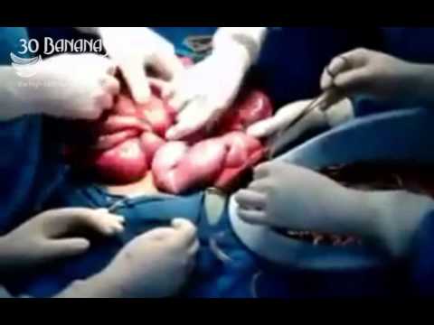 gross - 25 year old Bodybuilder colon infected with 'meat worms'. Its medically documented that young men eating diets high in animal protein are at extreme risk of ...