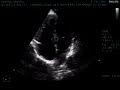 Unusual  ventricular septal defect
