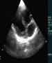 Unusual ventricular septal defect