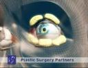 Blepharoplasty or Eyelid Surgery