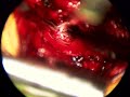 back surgery