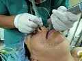 medico-anestesiologo-intubacion-nasal.html