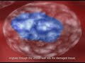 Stem Cell Injection Stem Cell Injection