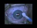 Lasik Redux Lasik Redux