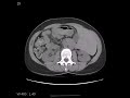 Click here to watch this video Radiology Rounds: CT of TRUE Situs Inversus (Abdominal/Pelvic CT)