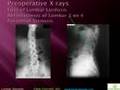 Lumbar Stenosis by Pablo Pazmino, MD