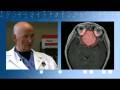 videos de Treating Brain Tumors with New Minimally Invasive CO2 Laser Fibers: Dr. Tew, Mayfield Clinic