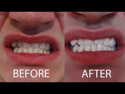 how to whiten heavily stained teeth