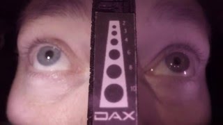 DAX™ Field Video 003 - HGN and vertical nystagmus and rebound dilation.