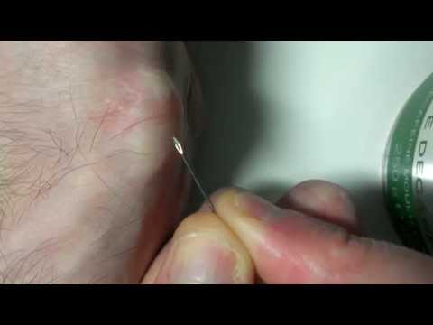 how to collect synovial fluid