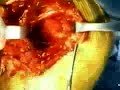 Axillary nerve