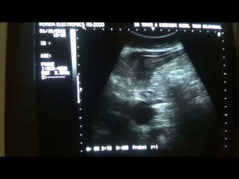 how to locate cbd on ultrasound
