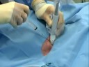 Internal Jugular Cannulation