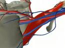 Internal Jugular Cannulation
