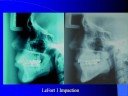 LactoSorb in Orthognathic Surgery with Dr. Barry Eppley