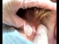 gross cyst