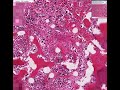 Histopathology Bone Marrow--Chronic idiopathic myelofibrosis Histopathology Bone Marrow--Chronic idiopathic myelofibrosis