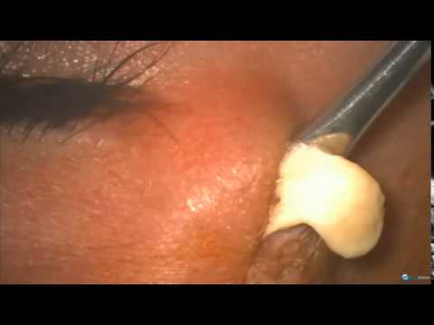 how to drain cyst on cat