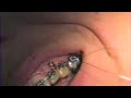 Tie in Technique for Closing Cuspid Space