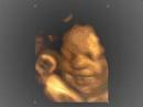 aborto   projeto raquel