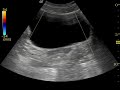 Ultrasound of a bladder filling