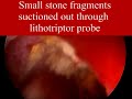 Percutaneous Nephrolithotomy Percutaneous Nephrolithotomy