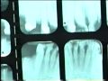 Metanfetamina y sus dientes Crystal Meth: The Wrong Road 6 Metanfetamina y sus dientes Crystal Meth: The Wrong Road 6