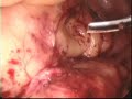 Sección Laparoscopica de Plexo Hipogastrico. Sección Laparoscopica de Plexo Hipogastrico.