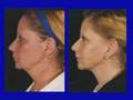 videos de Dr. Robert Silich, New York Plastic Surgeon Part 3 of 3