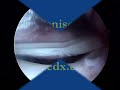 Meniscus Repair Surgery Dr. Allan Mishra Emedx.com
