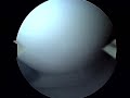 Meniscus Repair Surgery Dr. Allan Mishra Emedx.com