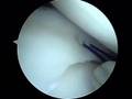Meniscus Repair Surgery Dr. Allan Mishra Emedx.com