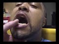 Home Dentistry(not for the squeamish)!!!!